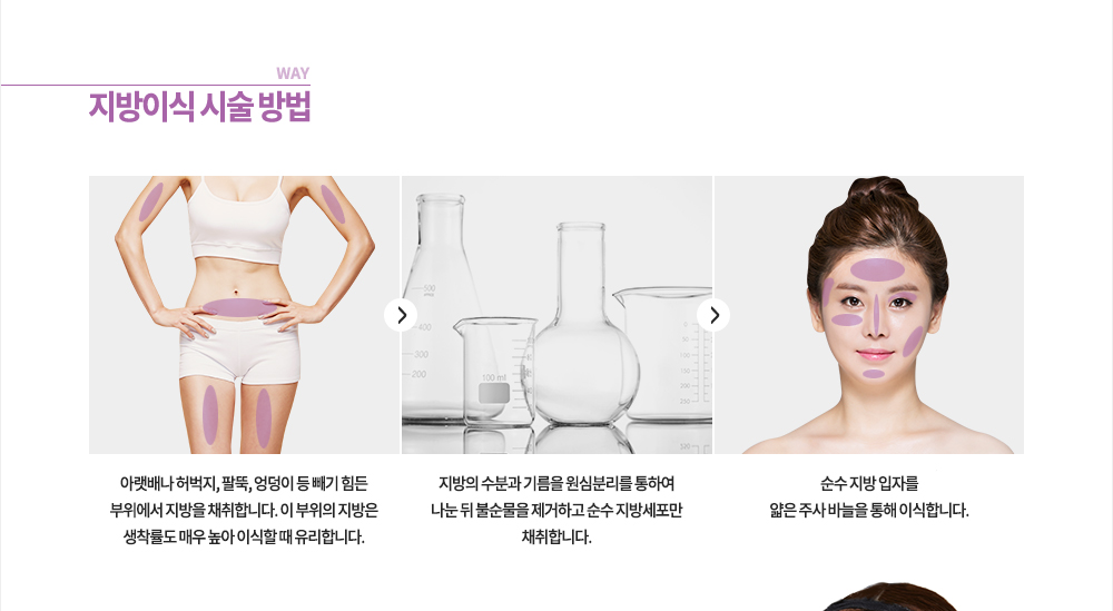 시술 방법 1.	아랫배나 허벅지, 팔뚝, 엉덩이 등 빼기 힘든 부위에서 지방을 채취합니다. 이 부위의 지방은 생착률도 매우 높아 이식할 때 유리합니다.
2.	지방의 수분과 기름을 원심분리를 통하여 나눈 뒤 불순물을 제거하고 순수 지방세포만 채취합니다.
3.	순수 지방 입자를 얇은 주사 바늘을 통해 이식합니다.

