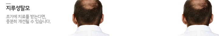 지루성탈모